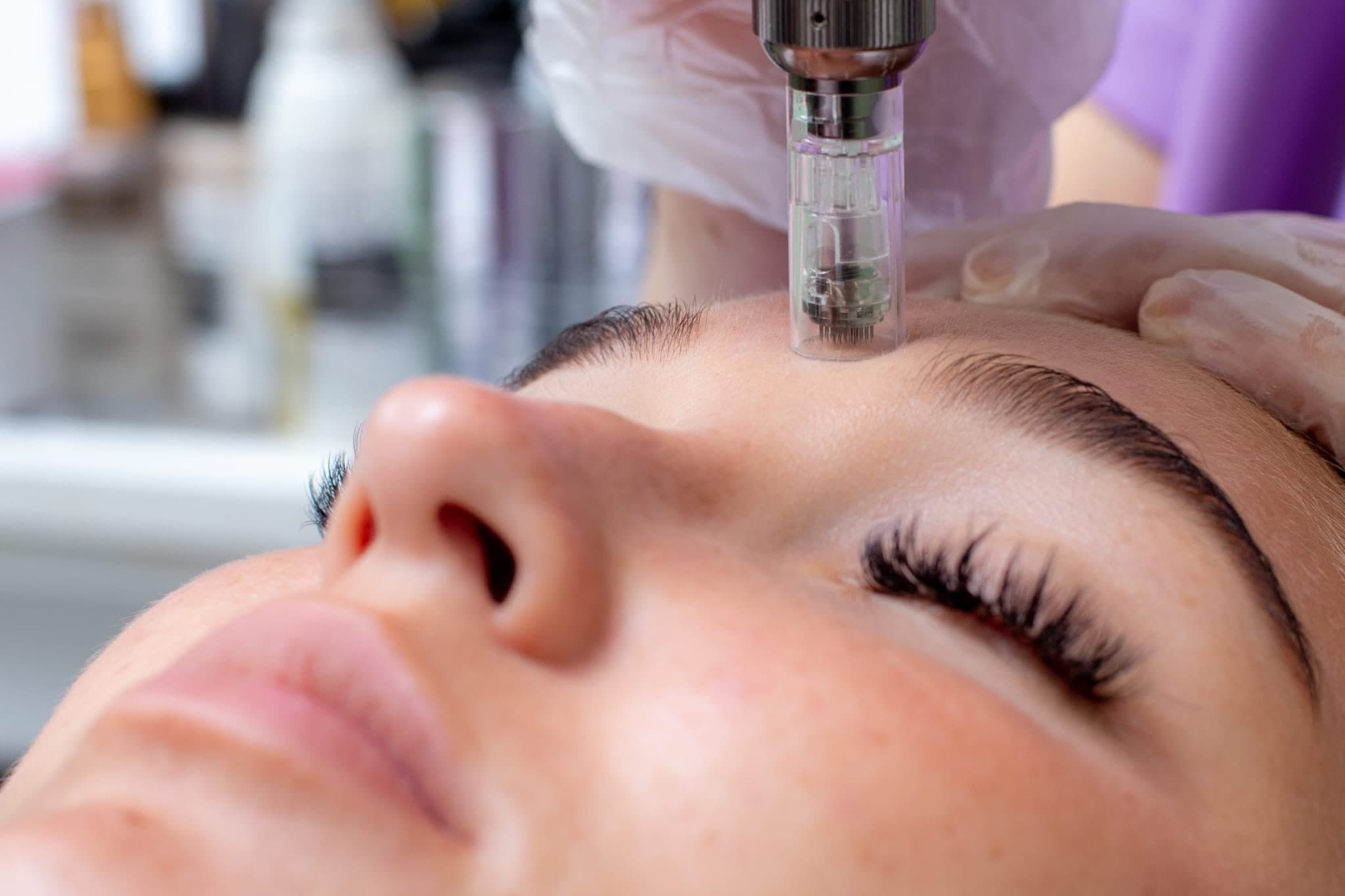 Tratament de microneedling cu dermapen pe fruntea unei cliente